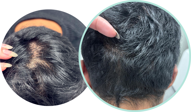 Haarpigmentierung SMP 